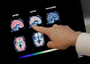 Alzheimer, la scoperta tutta italiana: scovato un responsabile della malattia finora sconosciuto